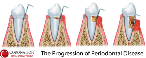 The Progression of Periodontal Disease
